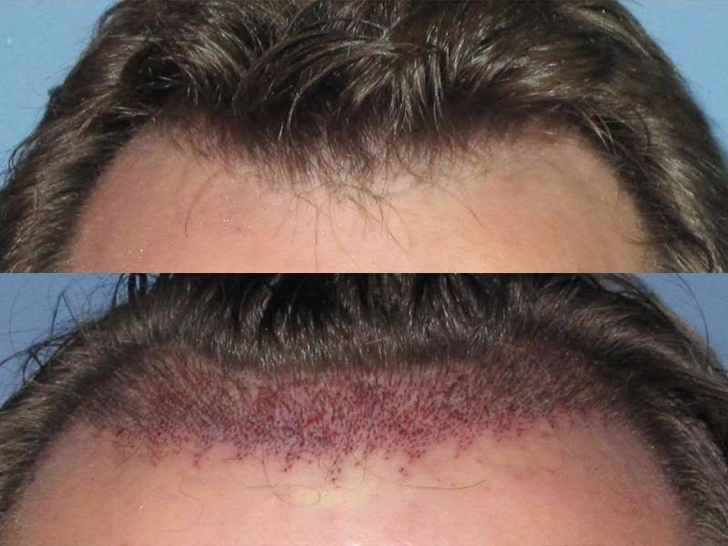 Qu’est-ce qu’un implant capillaire ?